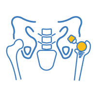 Hip replacement